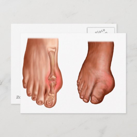Carte Postale Anatomie D'Un Pied Gonflé (Devant / Derrière)