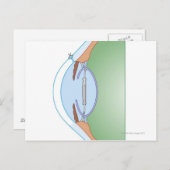 Carte Postale Chirurgie cataracte (Devant / Derrière)