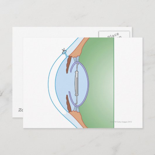 Carte Postale Chirurgie cataracte (Devant / Derrière)