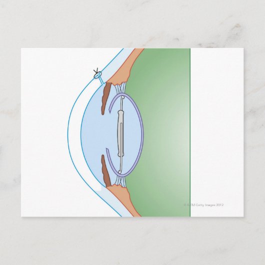 Carte Postale Chirurgie cataracte (Devant)