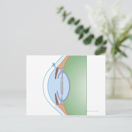 Carte Postale Chirurgie cataracte (Debout devant)