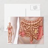 Carte Postale Diverticulite Dans La Région Du Colon Descendant (Devant / Derrière)