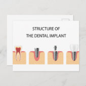 Carte Postale Faire-part Structure de l'implant dentaire (Devant / Derrière)