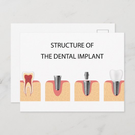 Carte Postale Faire-part Structure de l'implant dentaire (Devant / Derrière)