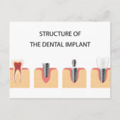 Carte Postale Faire-part Structure de l'implant dentaire (Devant)
