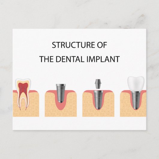 Carte Postale Faire-part Structure de l'implant dentaire (Devant)