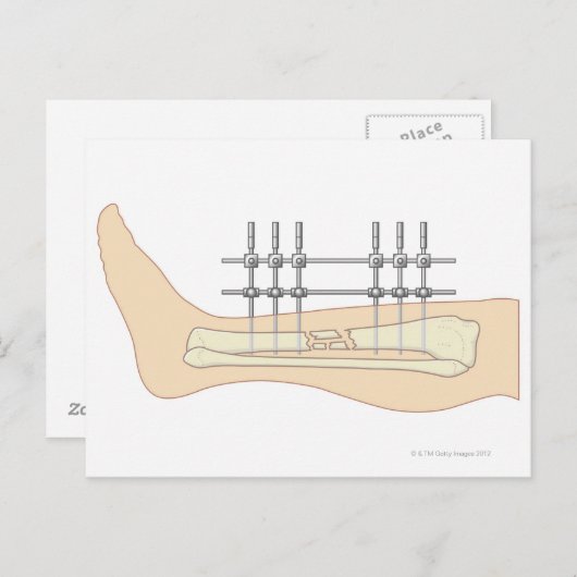 Carte Postale Fixateur externe (Devant / Derrière)