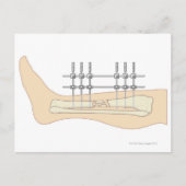 Carte Postale Fixateur externe (Devant)