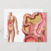 Carte Postale Illustration De La Diverticulose Dans Le Colon (Devant / Derrière)