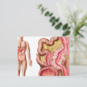 Carte Postale Illustration De La Diverticulose Dans Le Colon (Debout devant)