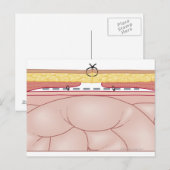 Carte Postale Illustration d'une hernie (Devant / Derrière)
