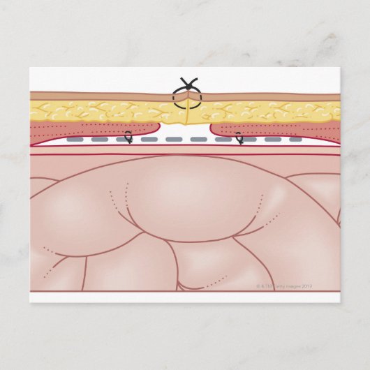 Carte Postale Illustration d'une hernie (Devant)