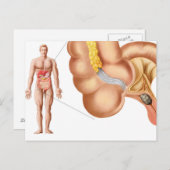 Carte Postale Illustration Médicale D'Un Appendice (Devant / Derrière)