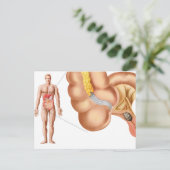 Carte Postale Illustration Médicale D'Un Appendice (Debout devant)