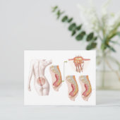 Carte Postale Illustration Médicale D'Un Cyst Pilonidal (Debout devant)