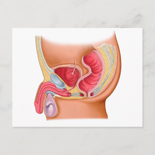 Carte Postale Illustration Médicale D'Une Fistule Rectouréthrale (Devant)