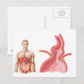 Carte Postale Illustration Médicale D'Une Hernie Hiatal Dans (Devant / Derrière)