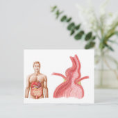 Carte Postale Illustration Médicale D'Une Hernie Hiatal Dans (Debout devant)