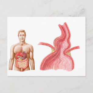 Carte Postale Illustration Médicale D'Une Hernie Hiatal Dans