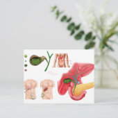 Carte Postale Illustration montrant la cholécystectomie (Debout devant)