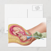 Carte Postale Illustration Montrant La Livraison Du Foetus 1 (Devant / Derrière)