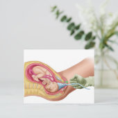 Carte Postale Illustration Montrant La Livraison Du Foetus 1 (Debout devant)