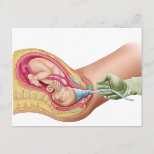 Carte Postale Illustration Montrant La Livraison Du Foetus 1
