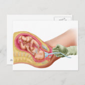 Carte Postale Livraison Du Foetus À L'Aide De L'Extraction Vacue (Devant / Derrière)