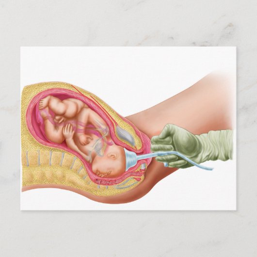 Carte Postale Livraison Du Foetus À L'Aide De L'Extraction Vacue (Devant)