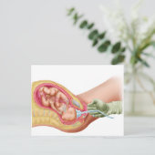 Carte Postale Livraison Du Foetus À L'Aide De L'Extraction Vacue (Debout devant)