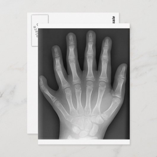 Carte Postale Polydactylo, Six Doigts, X-Ray, rareté ! (Devant / Derrière)