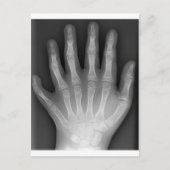 Carte Postale Polydactylo, Six Doigts, X-Ray, rareté ! (Devant)