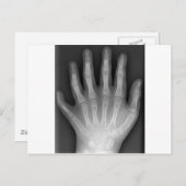 Carte Postale Polydactylo, Six Doigts, X-Ray, rareté ! (Devant / Derrière)
