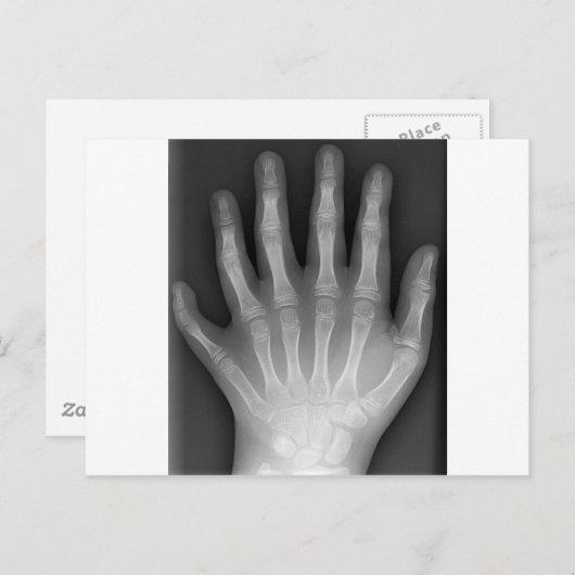 Carte Postale Polydactylo, Six Doigts, X-Ray, rareté ! (Devant / Derrière)