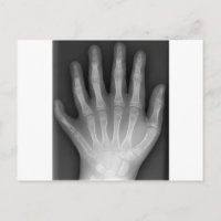 Polydactylo, Six Doigts, X-Ray, rareté !