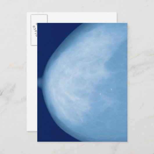 Carte Postale Rayon X du sein féminin, vue latérale (Devant / Derrière)