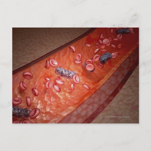 Carte Postale Rendu microscopique d'une infection sanguine (Devant)