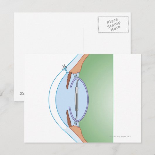 Cataractoperatie Briefkaart (Voorkant / Achterkant)