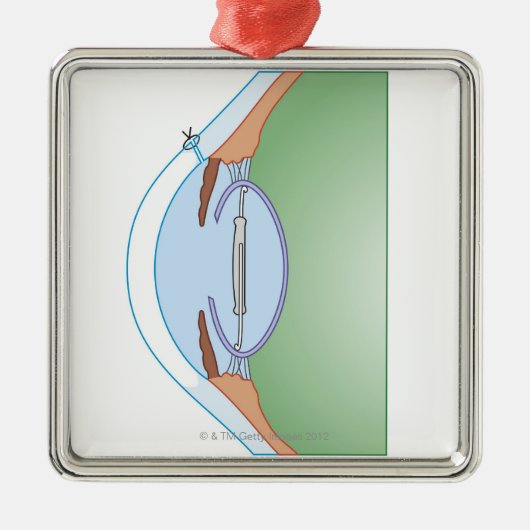 Cataractoperatie Metalen Ornament (Voorkant)