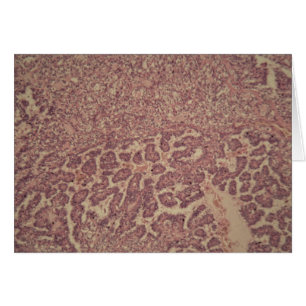 Cellules de glande thyroïde avec le cancer