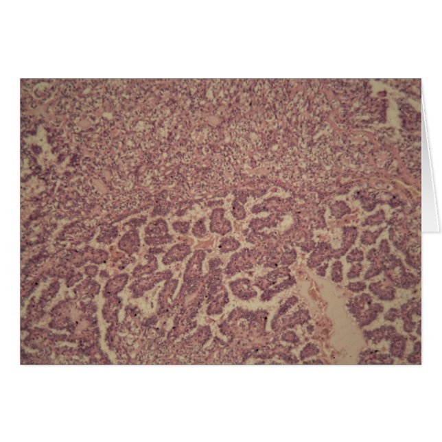 Cellules de glande thyroïde avec le cancer (Devant horizontal)