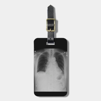 Chest X Ray ~ Bagagelabel