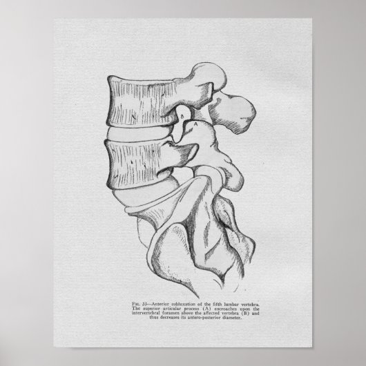 Chiropraktijkvertebrale subluxe  afdruk poster (Voorkant)