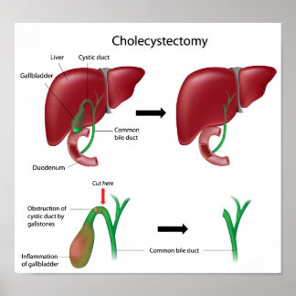 Cholecystectomie galblaasverwijderingsoperatie Pos Poster