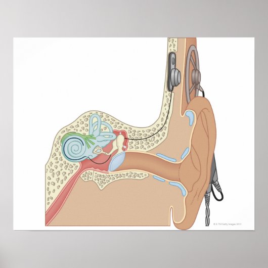 Cochlear Implantaten Poster (Voorkant)