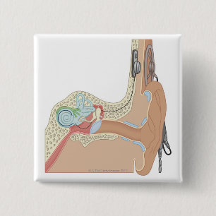 Cochlear Implantaten Vierkante Button 5,1 Cm