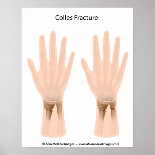 Colles fracture, medische illustratie. poster (Voorkant)