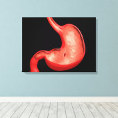 Conceptueel Afbeelding van eptische ulcera in buik Canvas Afdruk (Insitu (Houten vloer))