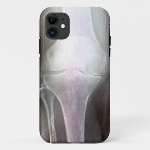 COQUE iPhone 11 COUVERTURE DU RAYON X IPHONE DE GENOU