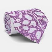 Cravate carcinome kystique adénoïde glande lacrique (Roulé)